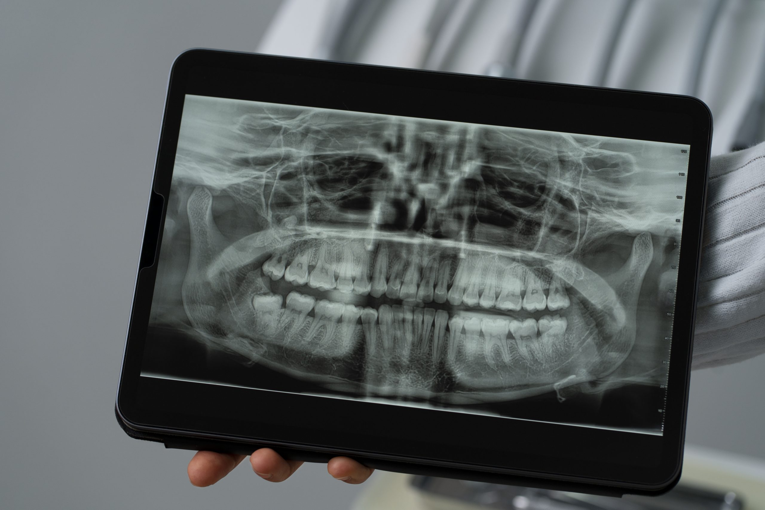 Advanced Dental Imaging: Understanding Cone Beam-Ray Scans