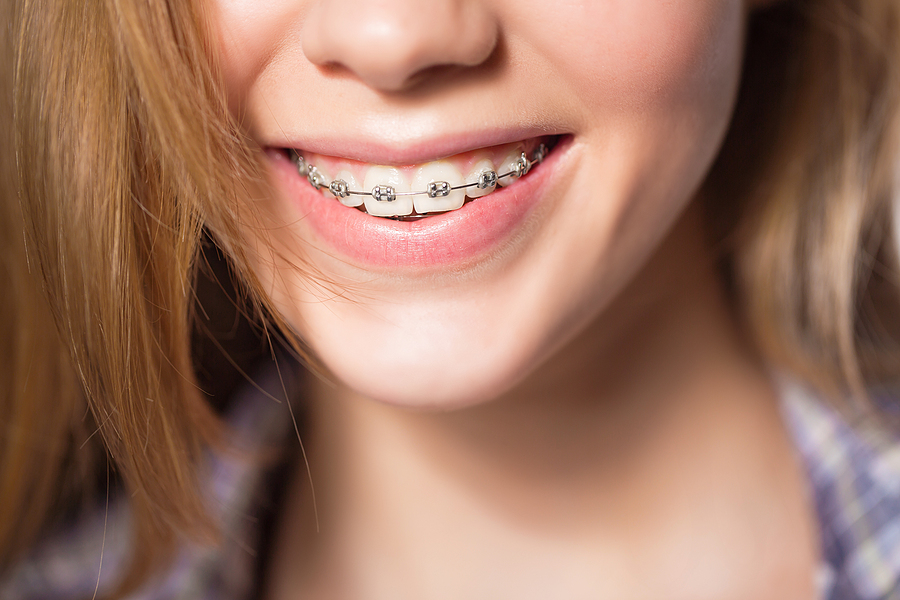 Transform Your Smile with Metal Braces in  Gaithersburg and Rockville, MD